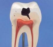 Сонник - Випадання зубів